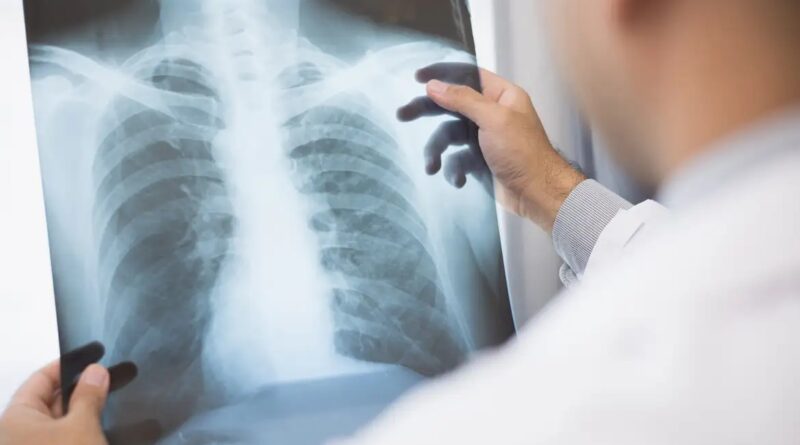 Anvisa aprova novo medicamento para câncer de pulmão avançado